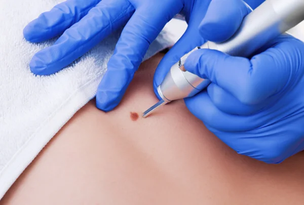 Radiofrequency Cautery